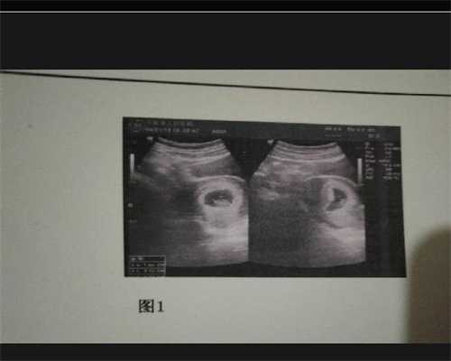广州品进峰代孕：分析一侧输卵管堵塞能怀孕吗