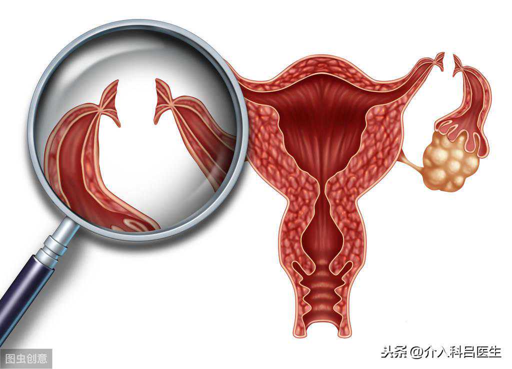 子宫肌瘤微创治疗后，会引起卵巢功能吗？医生给你讲解